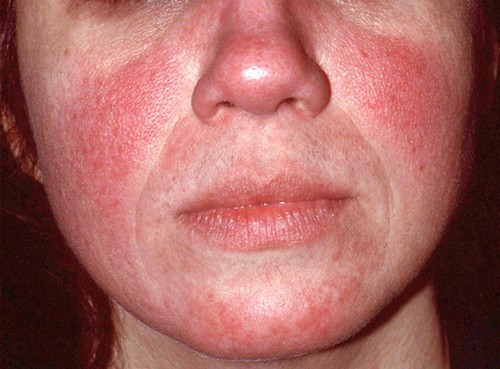 what is facial erytherma What is facial erytherma